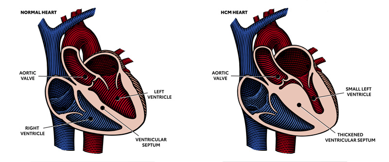 图显示正常心脏和一颗HCM