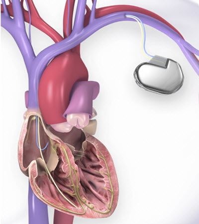 心脏和ICD的图示