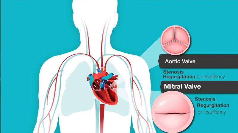 了解心脏杂音，主动脉和二尖瓣问题视频截图